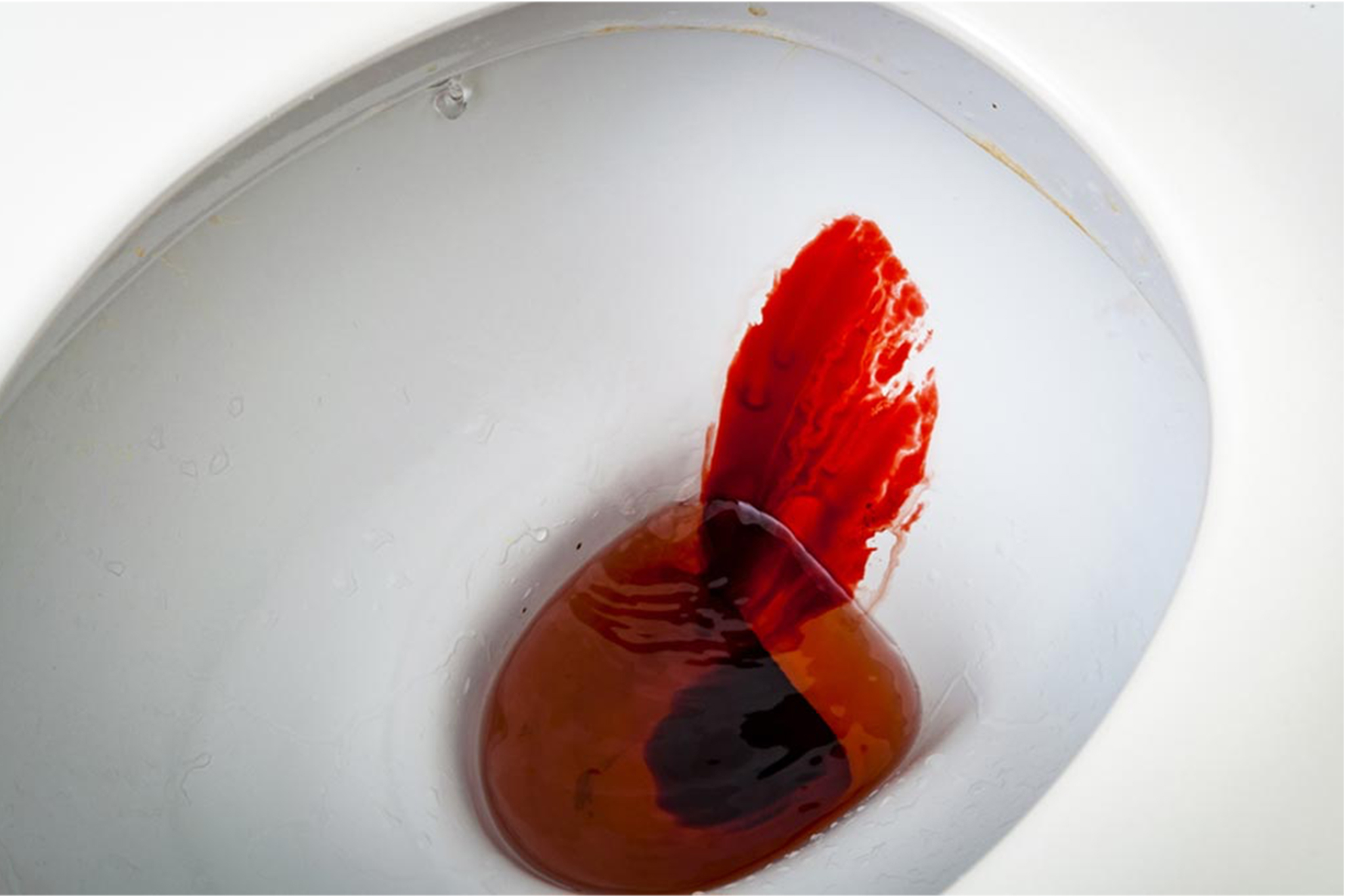 Gastrointestinal bleed